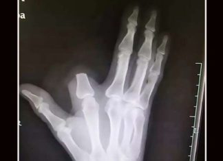 Un chinez și-a tăiat singur degetul după ce a fost mușcat de un șarpe, medicii spun că gestul lui a fost inutil