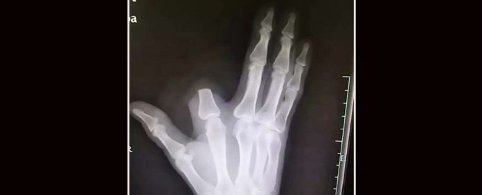 snake_bite_finger_amputation_1024