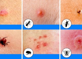 10 Mușcături de insecte pe care oricine ar trebui să le poată identifica