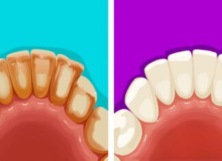 6 moduri naturale eficiente de îndepărtare a plăcii dentare