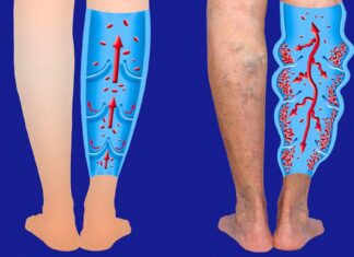 7 Exerciții de reducere a varicelor și a venelor tip pânză de păianjen