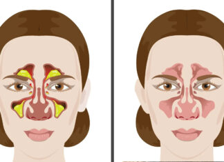 5 moduri ușoare de a elimina în mod natural mucusul și flegma