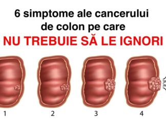 6 Simptome tăcute ale cancerului de colon pe care nu trebuie să le ignorați niciodată