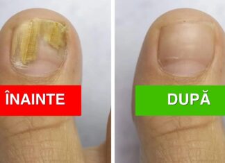 Dermatologii au explicat cauza ciupercii unghiilor (și cum să o remediezi)