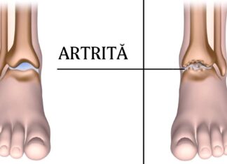 15 alimente care ajută la reducerea durerii cauzată de artrită