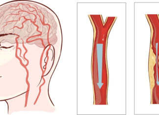 8 Obiceiuri sănătoase care te ajută să eviți un infarct sau un accident vascular cerebral