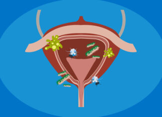 De ce apare des infecția urinară și cum să scapi de ea
