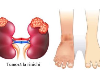 6 Probleme ale rinichilor pe care orice femeie ar trebui să le cunoască