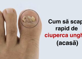 Cum să scapi rapid de ciuperca unghiilor (acasă)