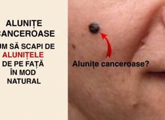 Alunițe canceroase: Cum să scapi de alunițele de pe față în mod natural