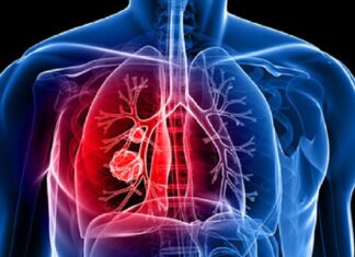 15 Semne că ai putea avea cancer pulmonar