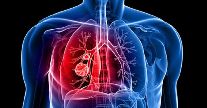 air-pollution-an-invitation-to-lung-cancer