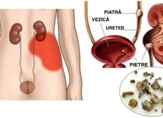 Ai nevoie de o curățare a rinichilor pentru a scăpa de pietre, oboseală, balonare, afecțiuni ale pielii și dezechilibre hormonale. Iată cum să elimini toxinele din rinichi