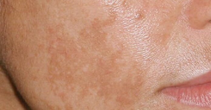 melasma-banner-768x402