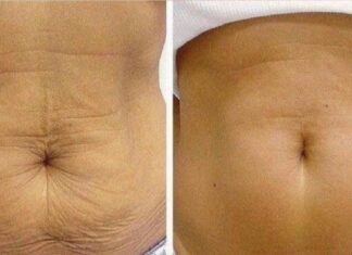 Cum să îi redai fermitatea pielii tale în mod natural. Fără a utiliza Botox și fără a apela la chirurgia plastică