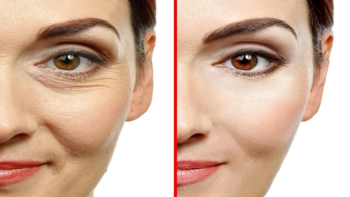 How-to-Make-A-Natural-Botox-With-Only-Three-Ingredients