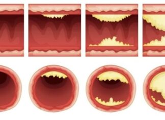 Top 10 alimente care desfundă în mod natural arterele și PREVIN atacurile de cord și accidentele vasculare cerebrale