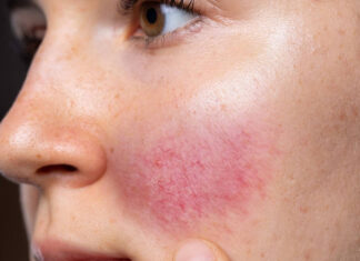 4 Remedii pentru a trata Rozaceea în mod natural