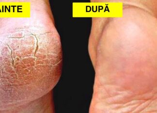Călcâie crăpate: 9 remedii naturale pentru a le vindeca RAPID
