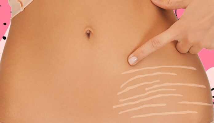stretch-marks-1647170984-lb