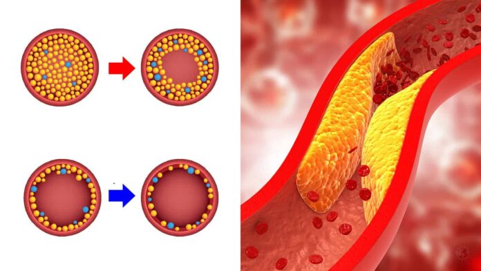 20-Things-to-Do-to-Reduce-High-Cholesterol