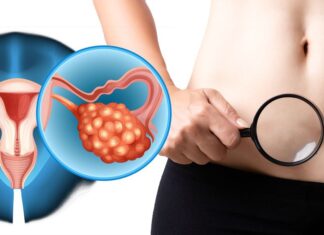 4 Simptome ale cancerului ovarian pe care fiecare femeie trebuie să le cunoască