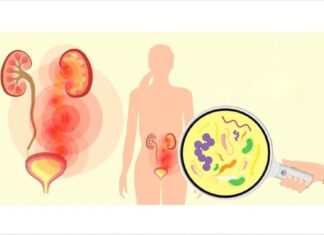 Infecție urinară: Cel mai bun antibiotic natural pentru infecția tractului urinar
