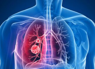 Semnele și simptomele cancerului pulmonar pe care oricine ar trebui să le cunoască