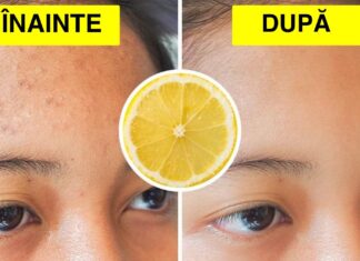 7 Alimente care vor reduce cicatricile provocate de acnee