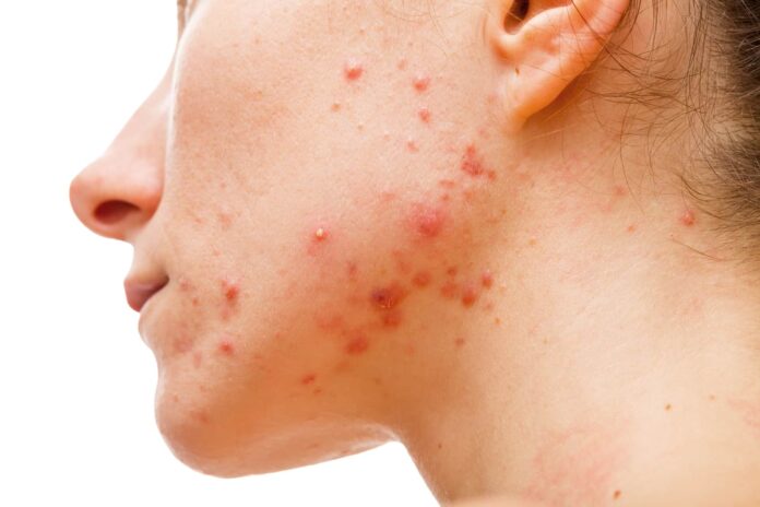 clear-skin
