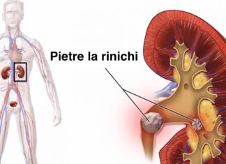 Pietrele la rinichi se elimină ușor cu acest remediu uimitor!