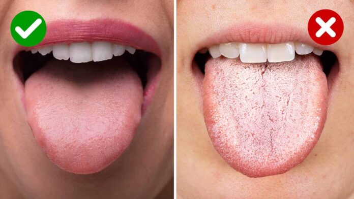 5-Things-a-White-Tongue-May-Reveal-About-Your-Health