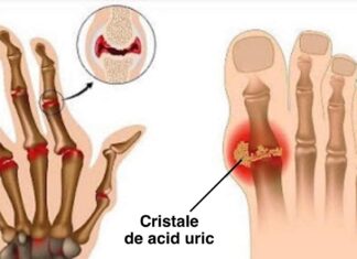 9 Alimente pe care nu trebuie să le mănânci niciodată dacă ai artrită