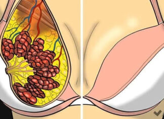 Cum să scapi de sânii lăsați? 5 Moduri naturale și simple de a vă ridica sânii fără intervenție chirurgicală