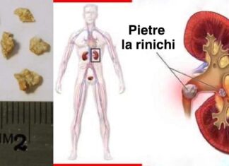 Modalități naturale dovedite de a trata sau de a preveni pietrele la rinichi (pe baza științei)